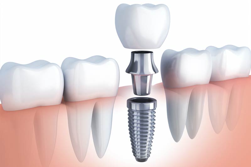 Implants Dentist in Lancaster